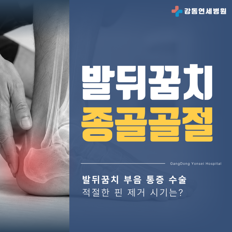 0806_발뒤꿈치_중골_골절.png