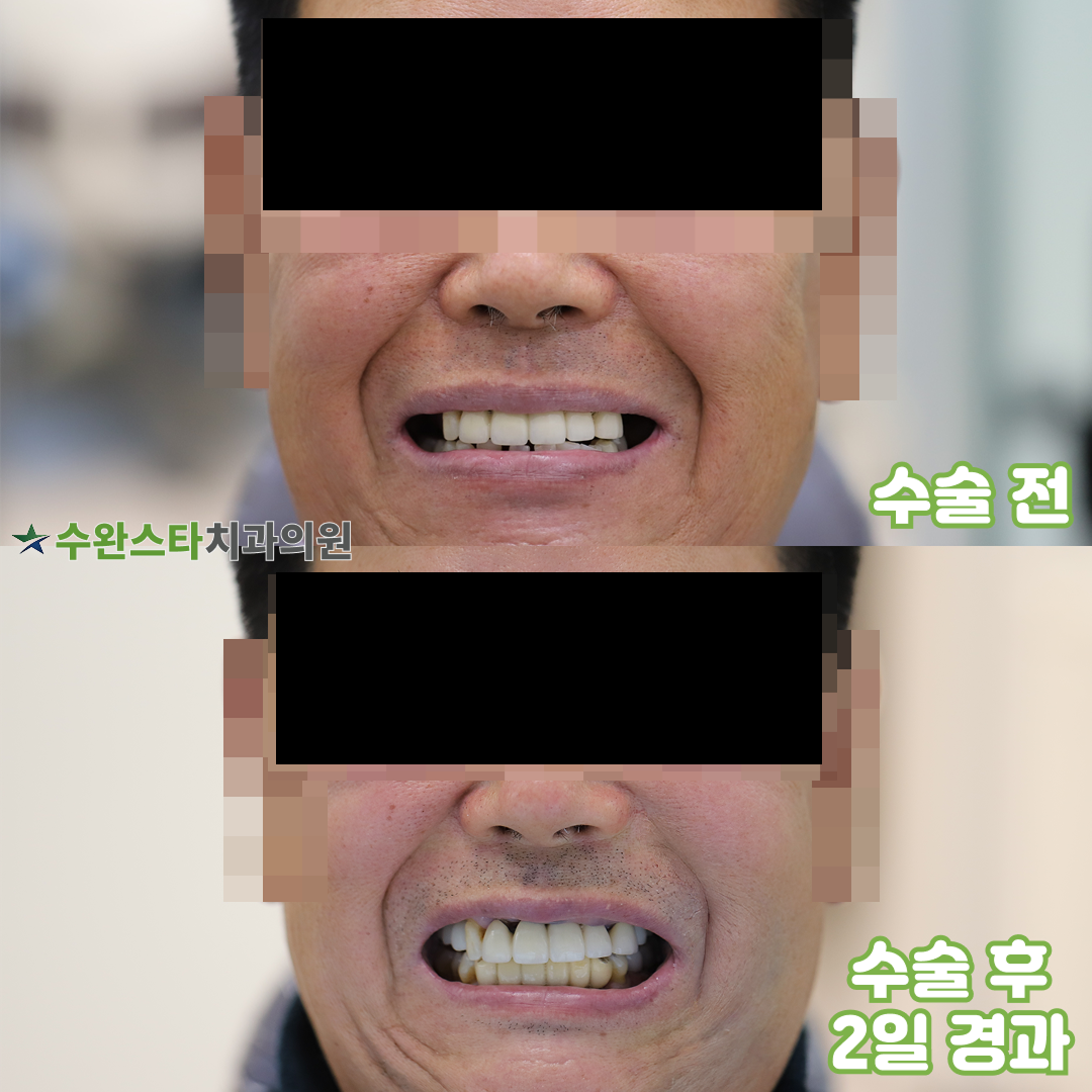 수술 전 / 수술 후 2일 경과, 60대 남성 (2025. 11 촬영)