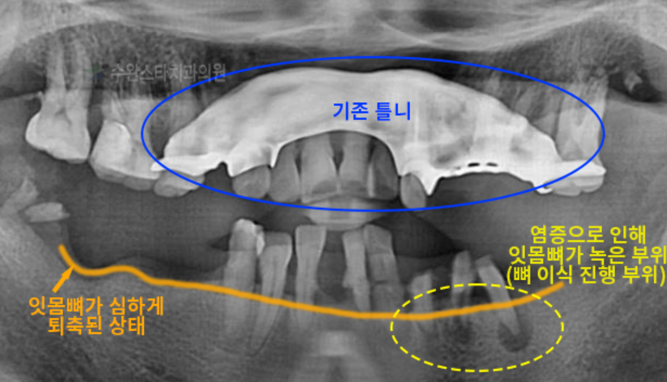 발치 후 임플란트 기간 궁금하셨던 환자분의 파노라마 치아 사진