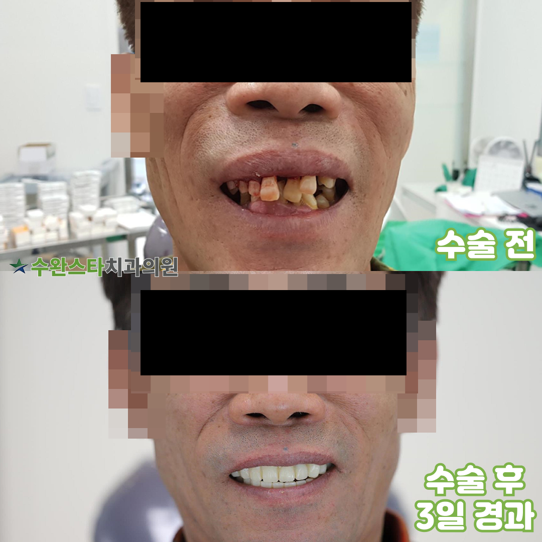 수술 전·후 3일 경과 미소 비교 사진 — 50대 남성 임시치아 장착 후 자연스러운 웃음