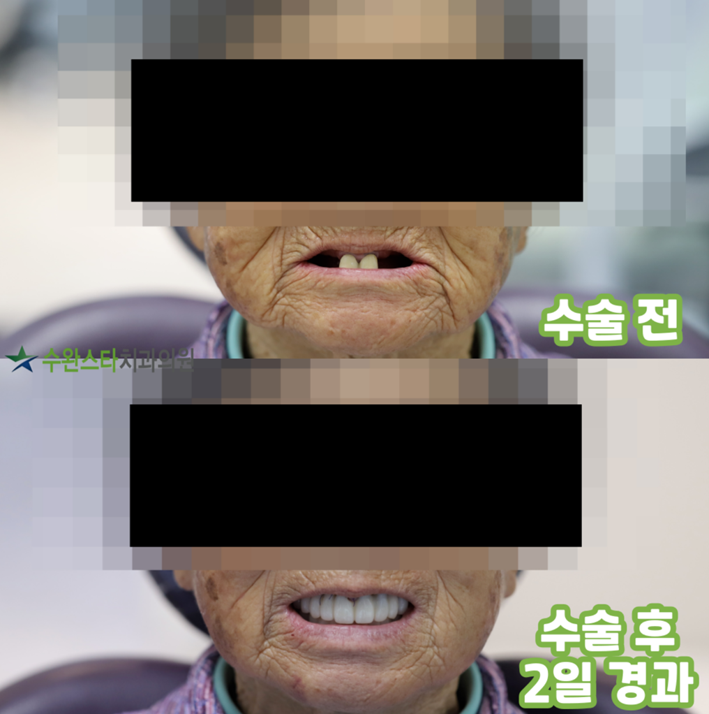 임플란트 뼈이식 후 식사를 안정적으로 하실 수 있었던 환자분의 수술전과 수술2일후 사진