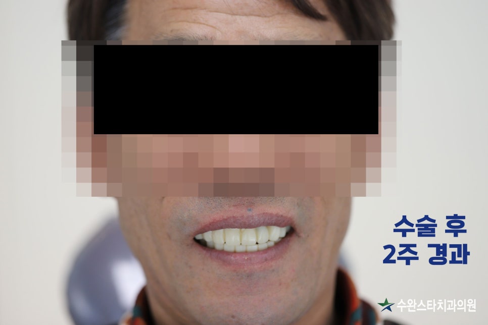 수술 후 2주 경과 — 임시치아 장착 상태, 50대 남성 전악임플란트 결과