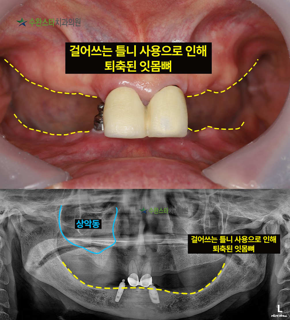 임플란트 뼈이식 후 식사가 걱정이었던 80대 환자분의 구강 내부 사진과 파노라마 사진
