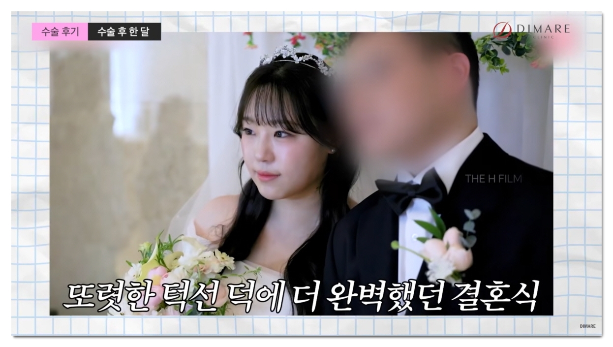 브이라인 시술, 브이라인 지방흡입