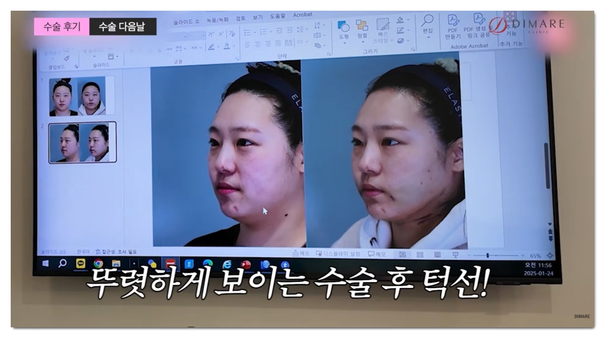 브이라인 시술, 얼굴살