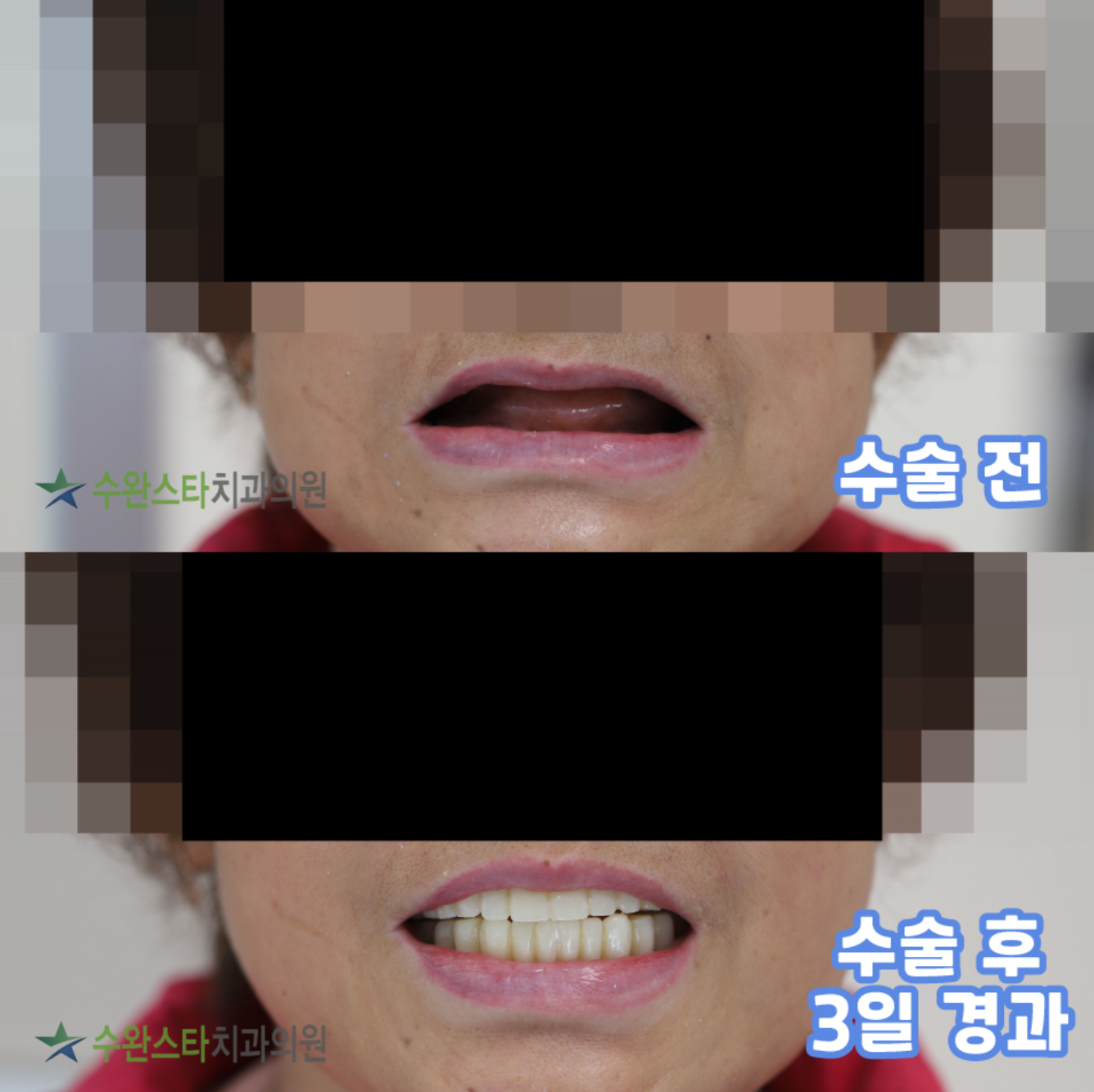 발치 후 임플란트 기간 당일 식립하신 환자분의 수술 후 3일 경과 사진