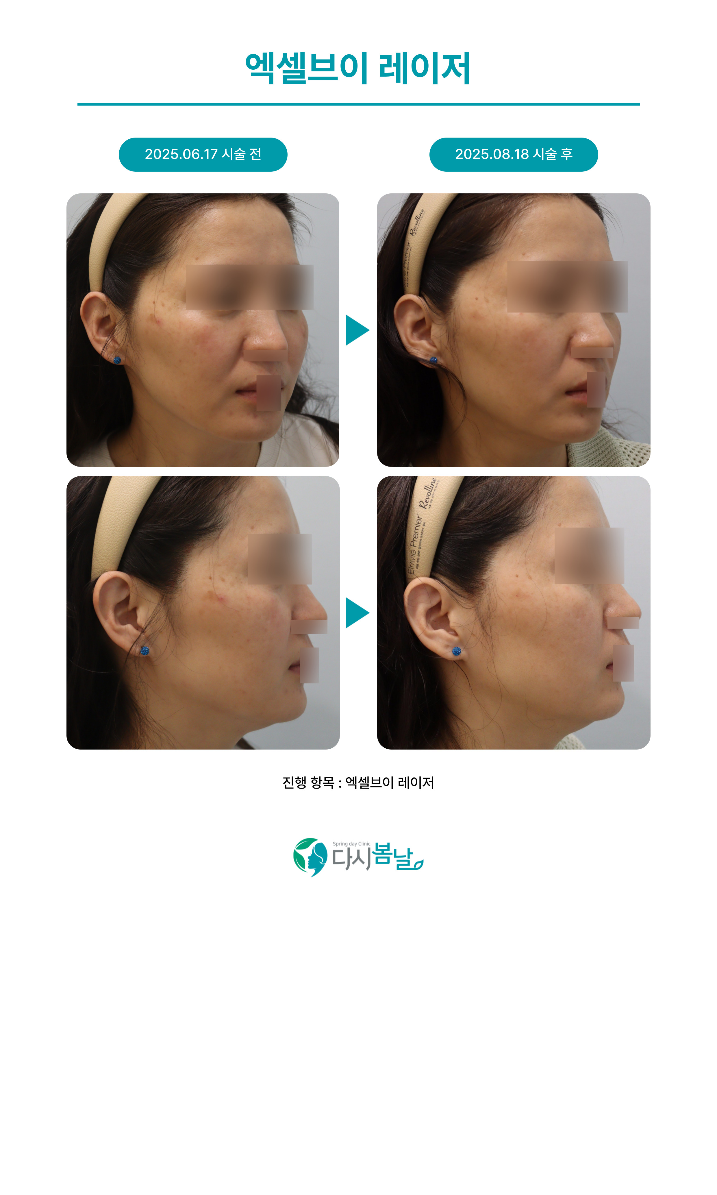 엑셀브이 레이저 : 다시봄날의원 과천점