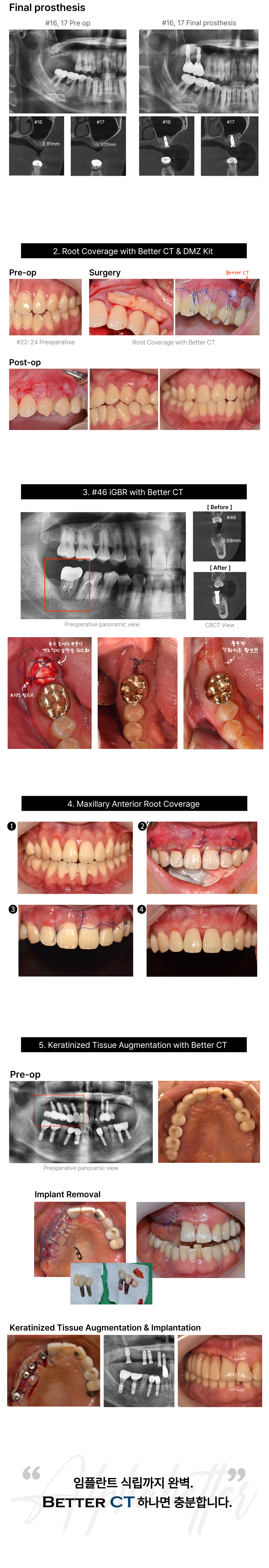 Better CT (Connective Tissue)