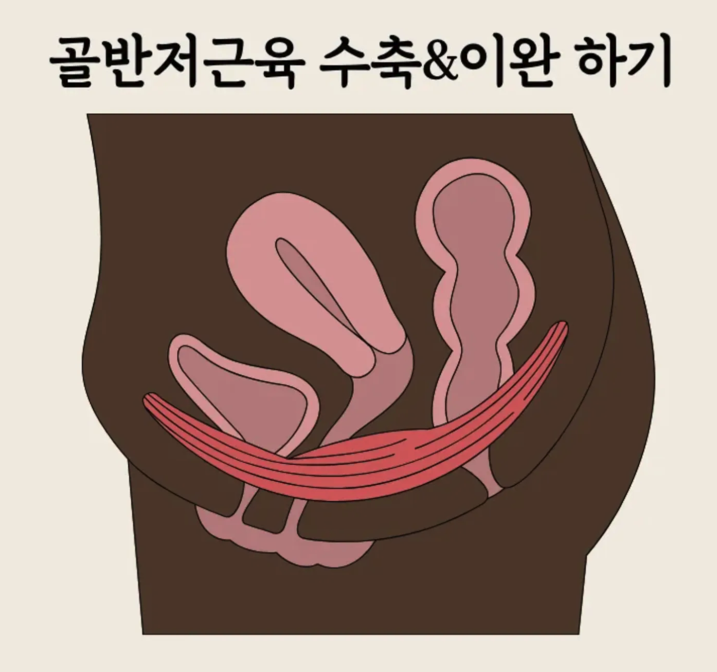 복압성요실금 요실금수술 요실금