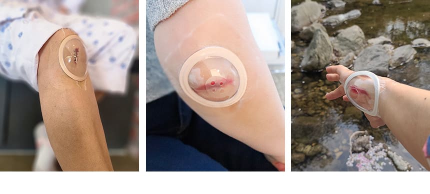 성인 무릎에 안다찌 일반형 사용 사례