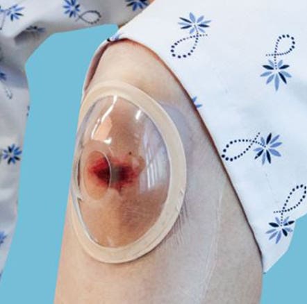 무릎 수술 상처 보호 – 안다찌 소독형 상처보호캡 착용 예시