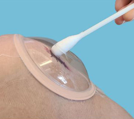 안다찌 소독형 상처보호캡 드레싱 사용 예시 – 면봉 도포 가능
