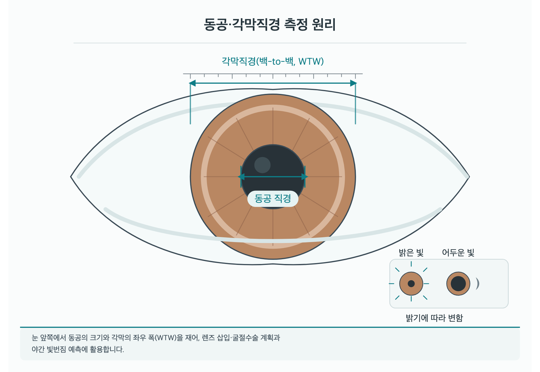 동공·각막직경 측정, 수술 전에 왜 필요할까요? 원리 도해