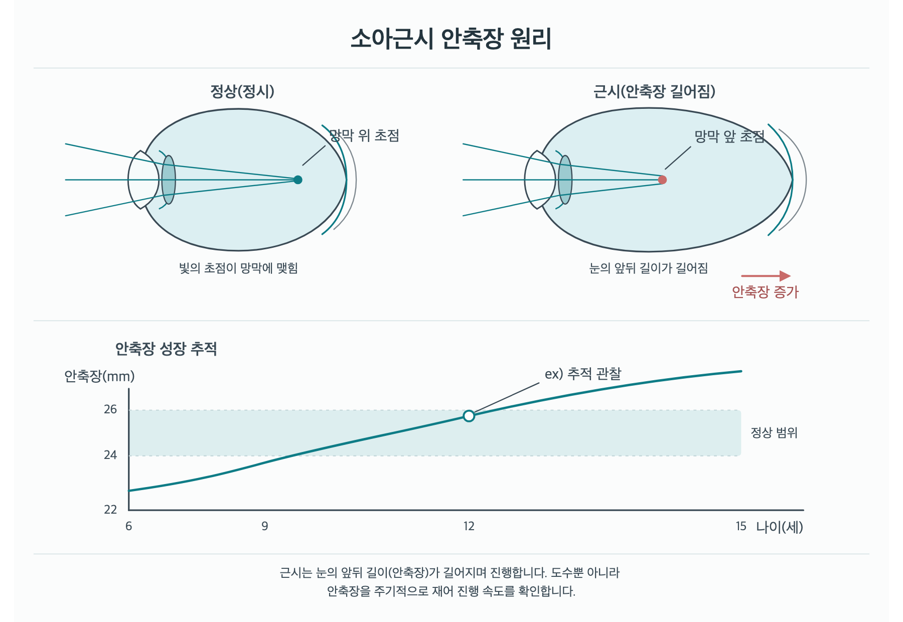 아이 근시, 안경 도수 말고 눈 길이도 재야 하나요? 원리 도해