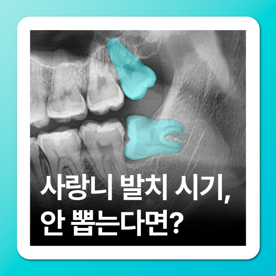 누운 사랑니 증례 썸네일