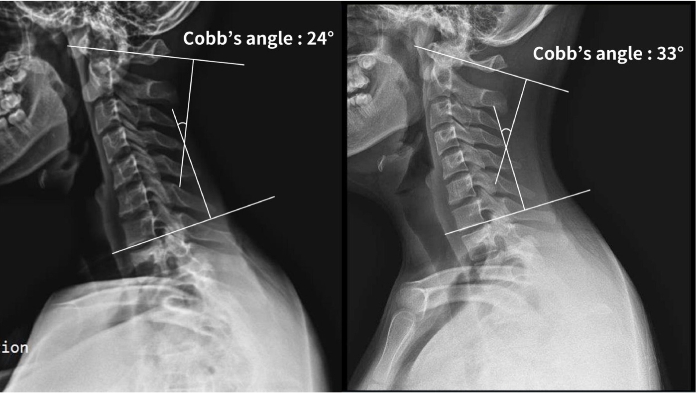 상부경추 X-ray 측면 분석 - Cobb's angle 비교