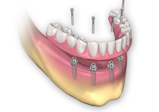 New Implant 이미지