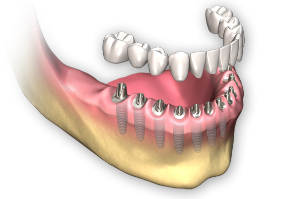 Old Implant 이미지