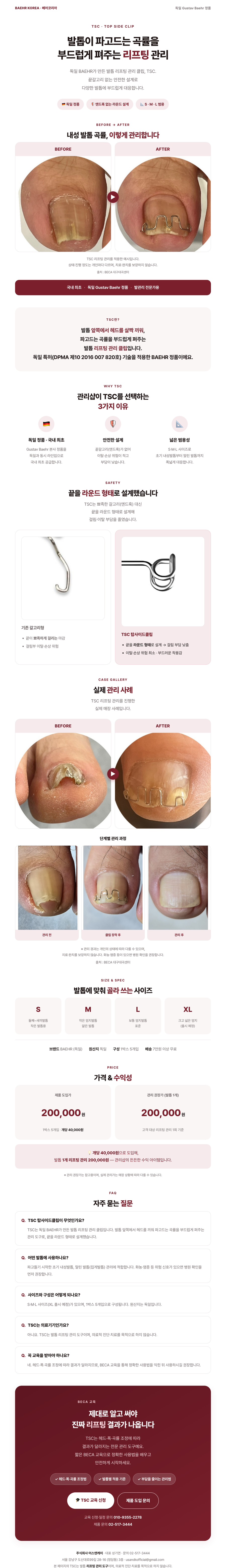 TSC (내성 발톱 교정을 위한 와이어)