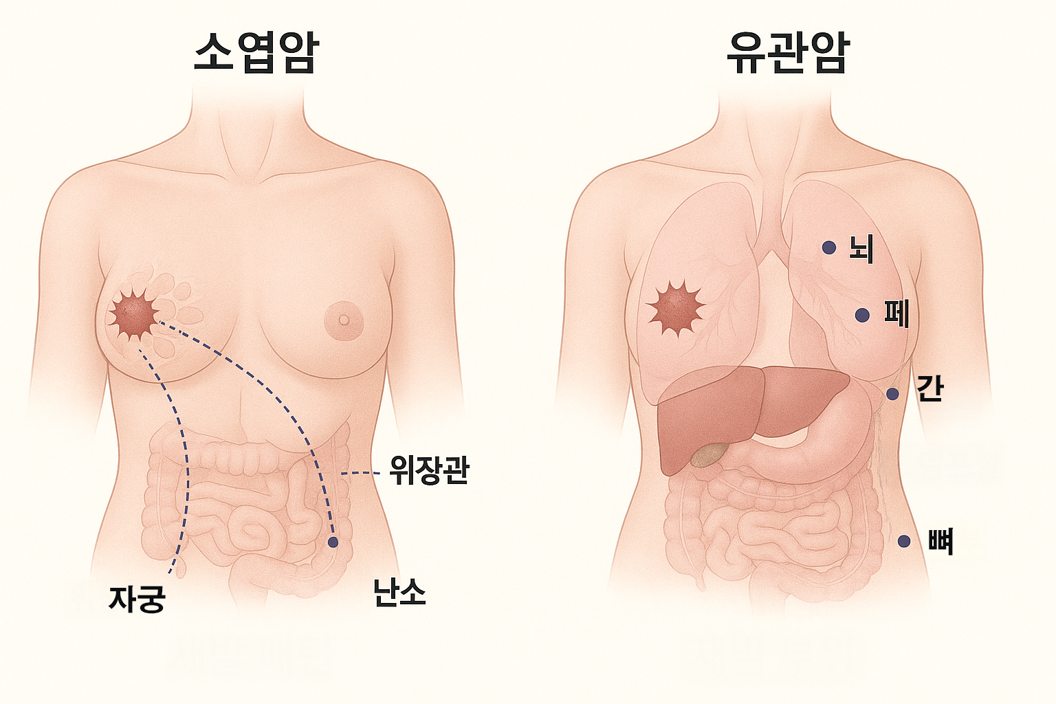 소엽암과 유관암 재발패턴