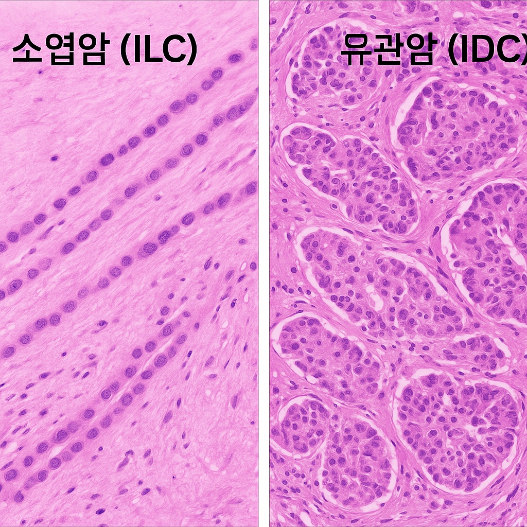 소엽암과 유관암