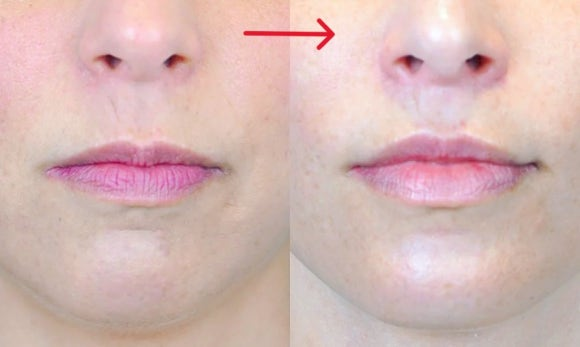 Before and after photos of a philtrum reduction patient, showing shortened philtrum and rejuvenated appearance.