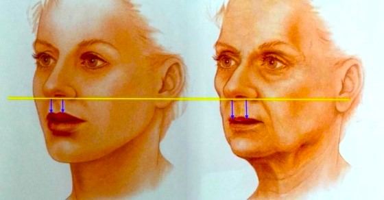 Side-by-side comparison of a young and older woman’s facial profile, illustrating philtrum elongation with aging.