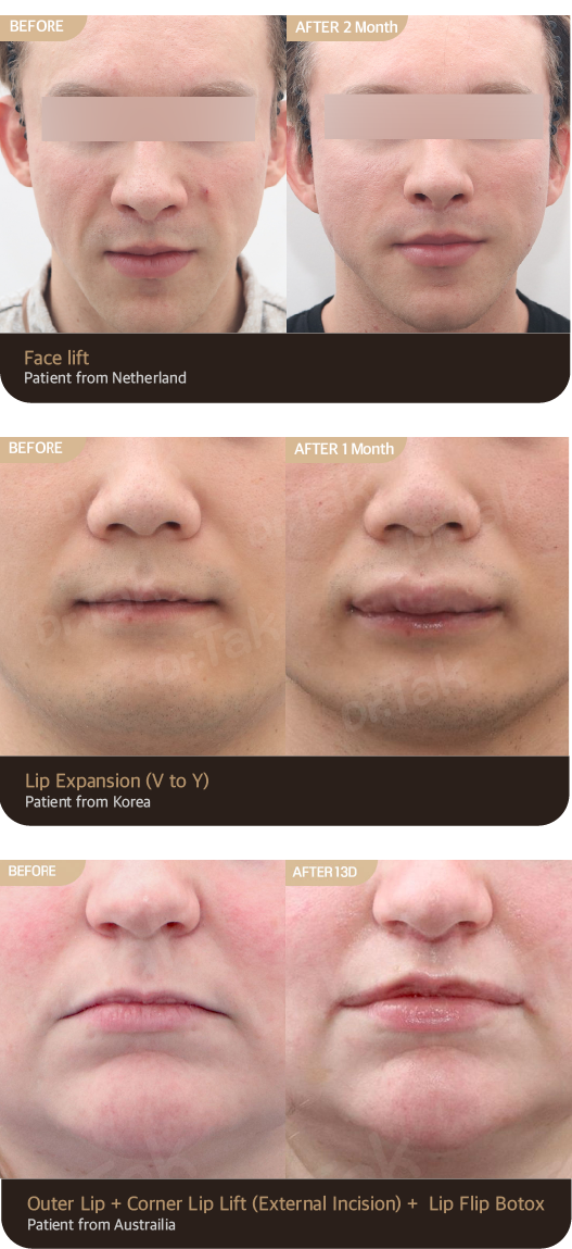 Before & After — All cases