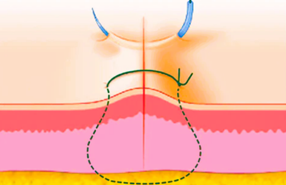 Cross-sectional illustration of philtrum reduction surgery, depicting the internal structure and surgical technique.