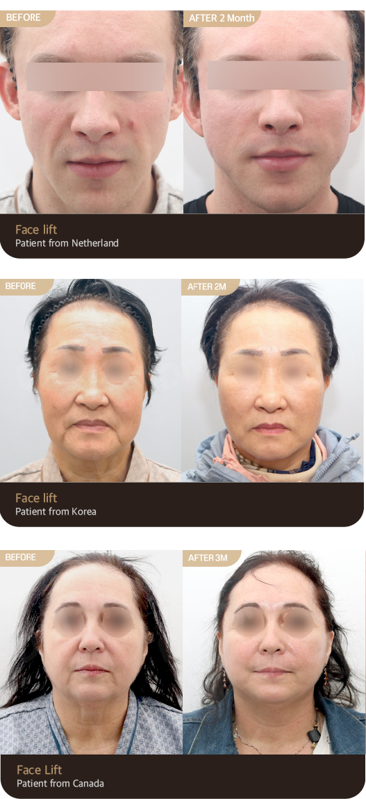 Before & After — Face Lift cases