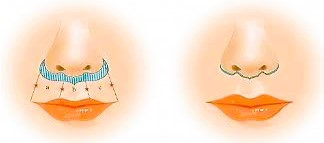 Diagram of the incision design used in philtrum reduction surgery, showing preoperative and postoperative plans.