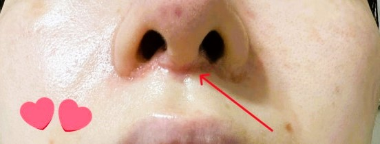 Close-up of a patient's nostrils before post-operative scar treatment, showing visible incision line from philtrum reduction surgery.