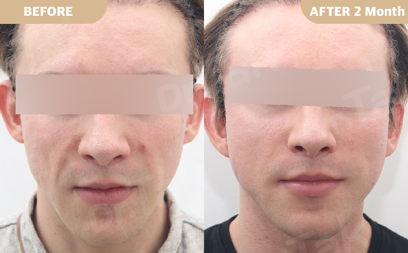 Deep Plane Facelift — Before & After