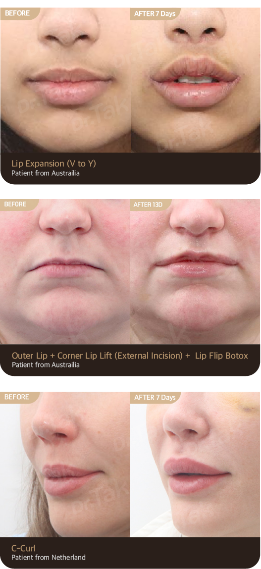 Before & After — Lip Lift cases