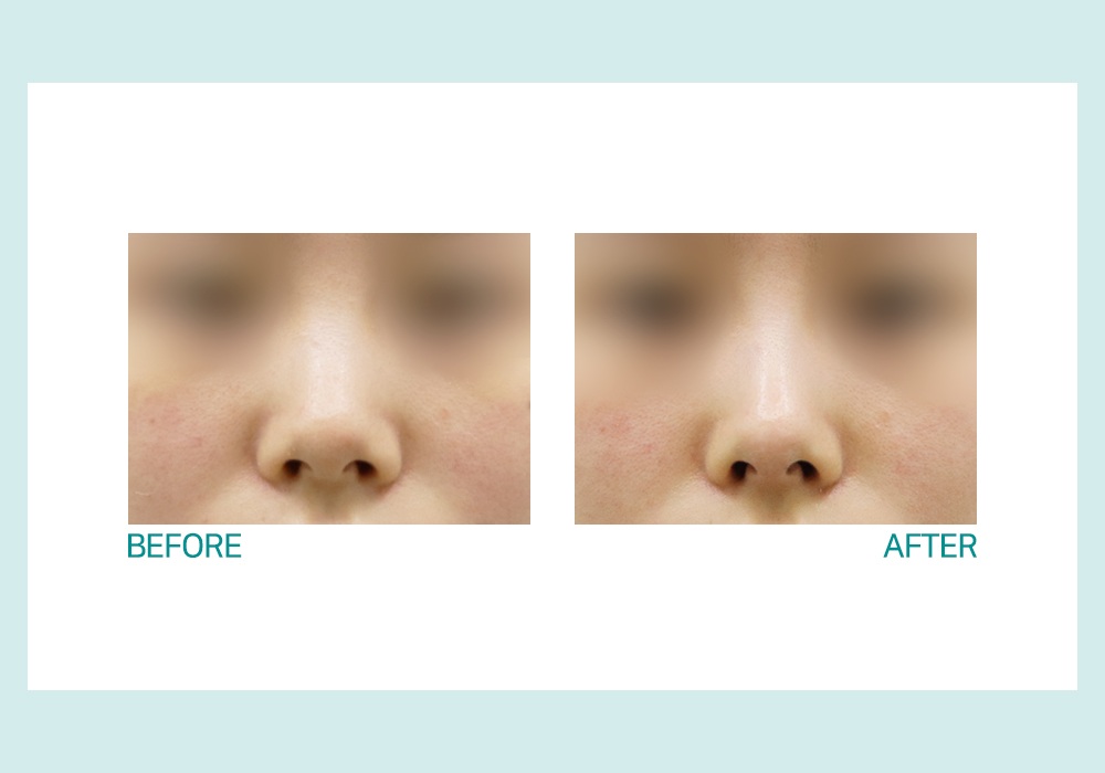 전후사진_김선영_코필러_211207 - 수정본.jpg