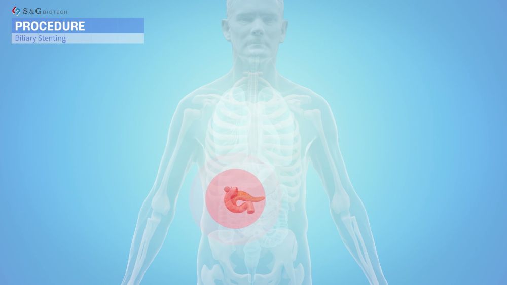 인체 내부에서 췌장의 위치와 주변 장기를 3D로 시각화한 의료 이미지