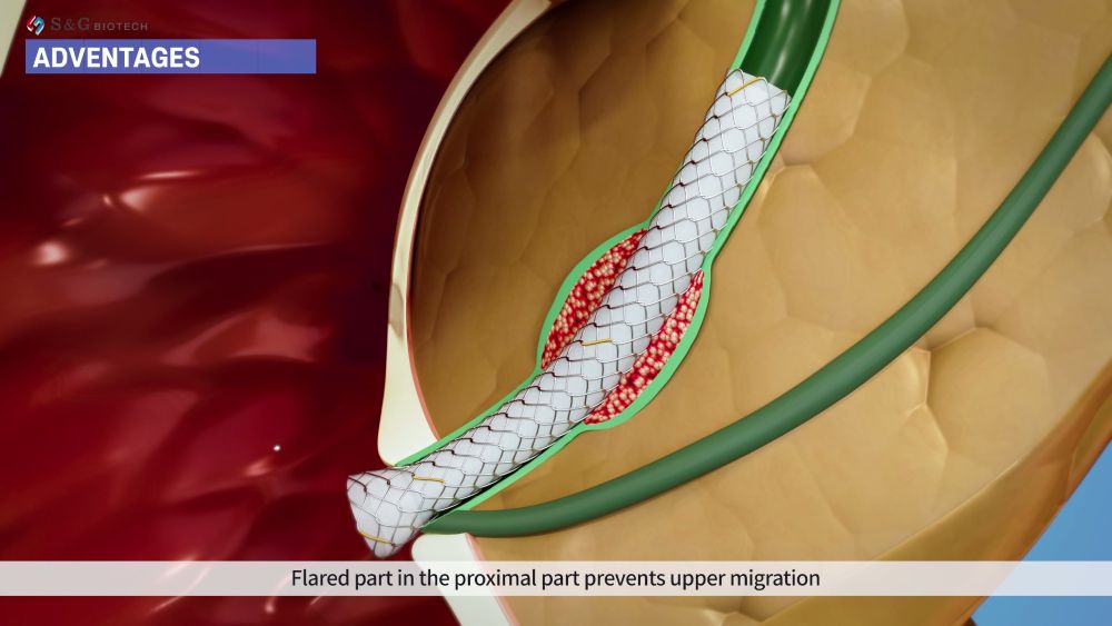 췌담관 내부에 스텐트가 안정적으로 안착된 상태를 3D로 표현한 의료 시각화 이미지