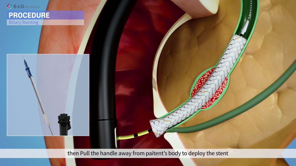 내시경 시점을 기반으로 스텐트가 췌담관에 삽입되는 시술 과정을 3D로 표현한 의료 시각화 이미지