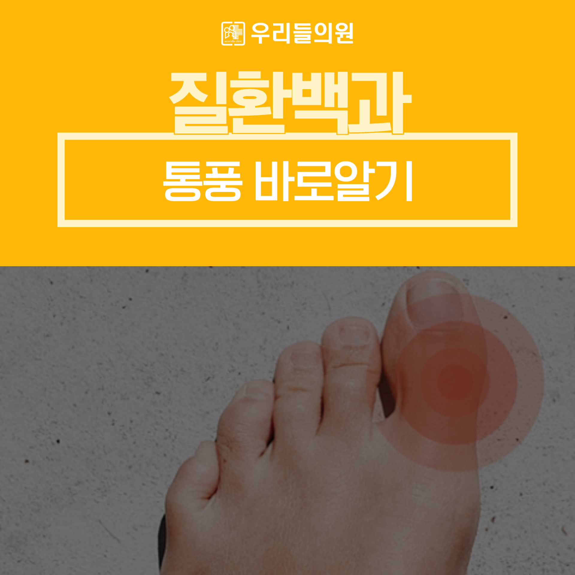 통풍