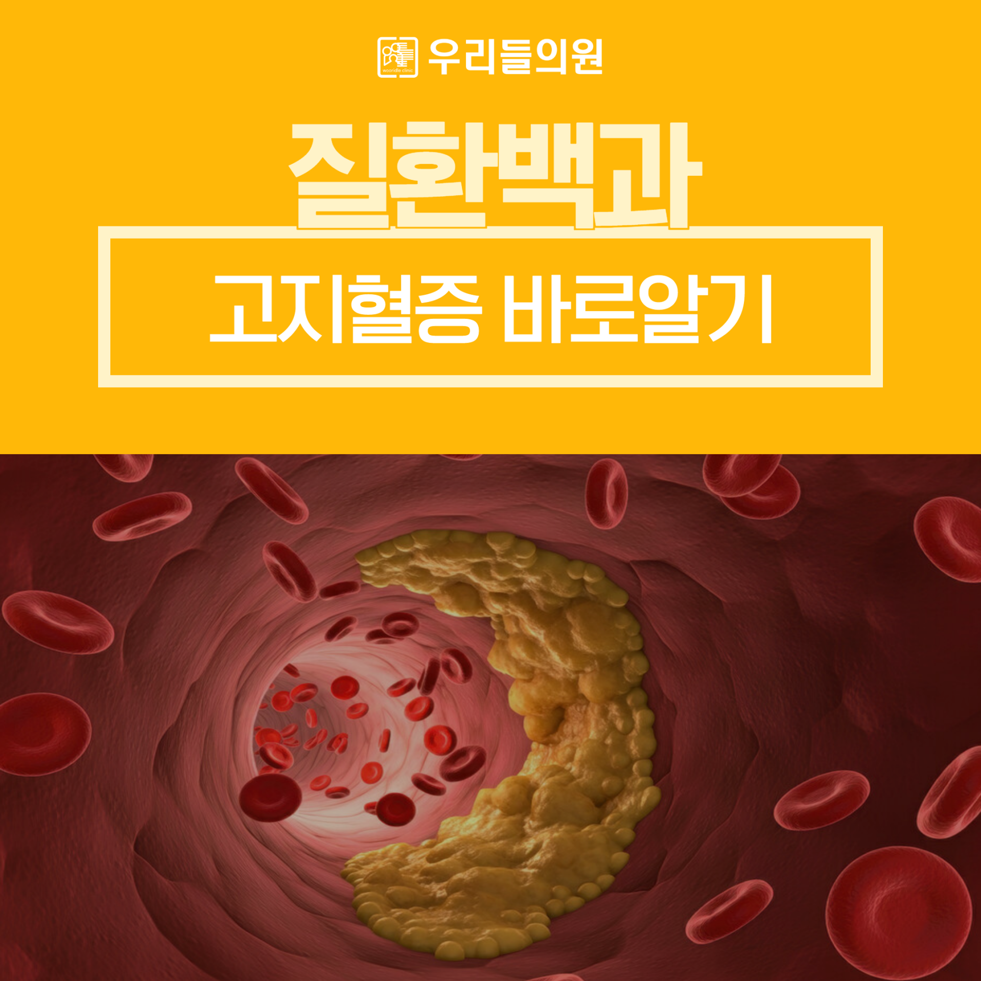 고지혈증