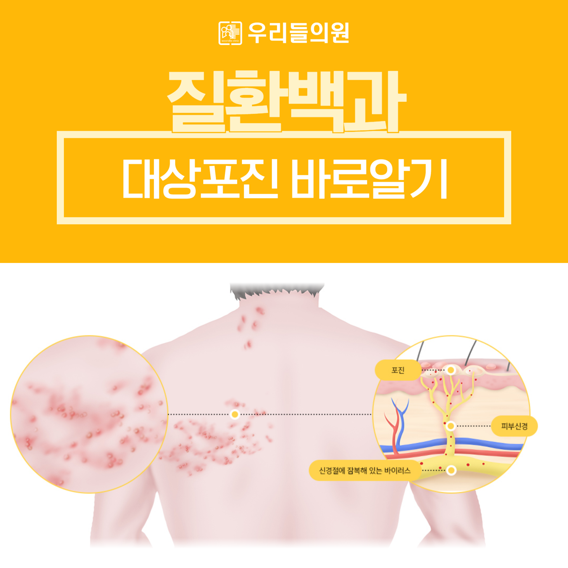 대상포진