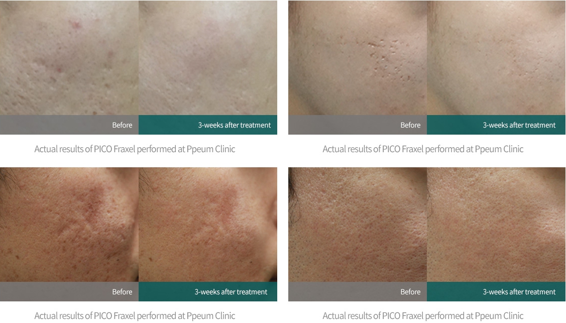 Ppeum Clinic's acne scars removal