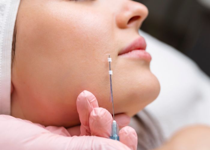 what is this nose Thread Lift