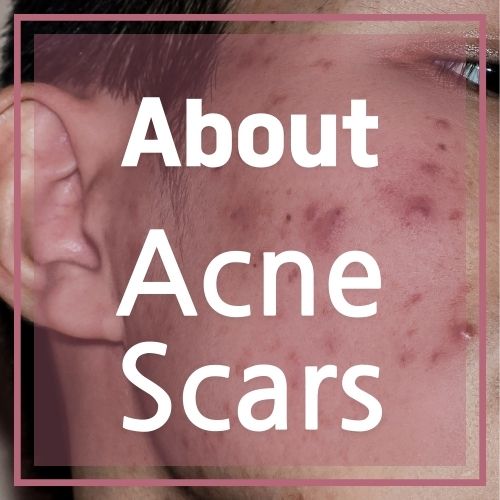 about Acne scars