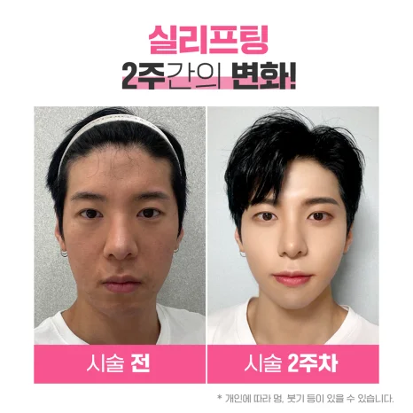 韓国 糸リフト施術の2週間後ビフォーアフター男性症例