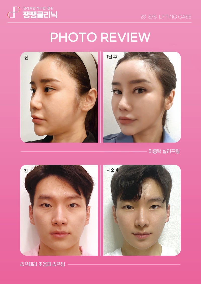 韓国 糸 リフトでフェイスラインが引き締まった女性のビフォーアフター｜ペンペンクリニック