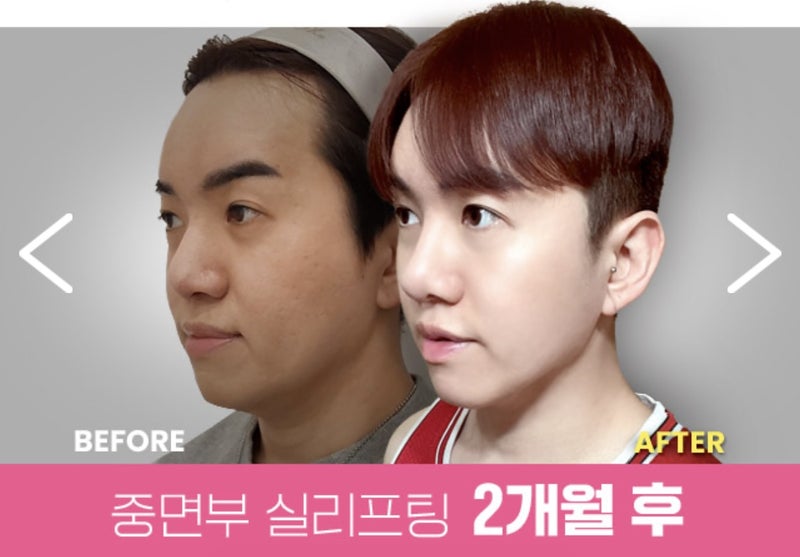 韓国 糸リフト 男性中顔面（ミッドフェイス）2ヶ月後のビフォーアフター症例