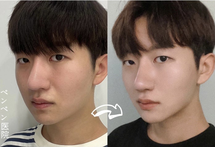 韓国 糸 リフトで若々しい印象に変化した男性の症例｜ペンペンクリニック