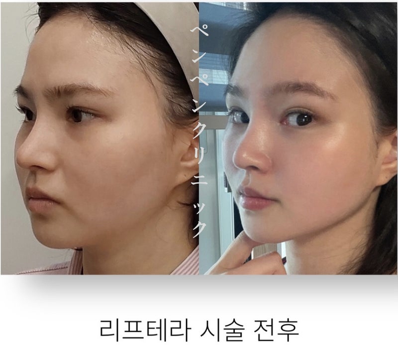 韓国 糸 リフトで自然なVラインを実現したペンペンクリニックの症例写真（リフテラ施術前後）