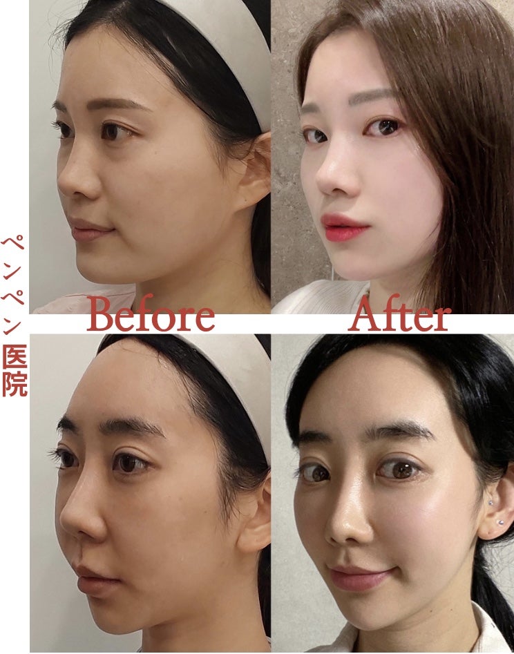 韓国 糸 リフトで若々しく小顔になったビフォーアフター｜ペンペンクリニック